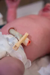 Close-up of a baby's umbilical cord.