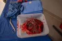 Placenta and Umbilical Cord After Birth.