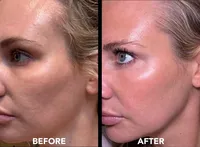 Microneedling