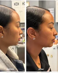 chin+filler
