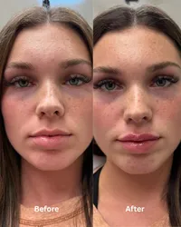 Before+and+after+1_2+syringe