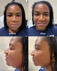 cheek+filler