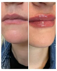 lip-filler-injectable-before-and-after-beau-montana-2