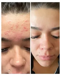 skin-and-facials-before-and-after-beau-montana-2