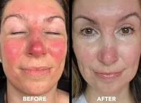 Microneedling+2