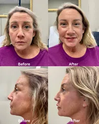 Lip+filler