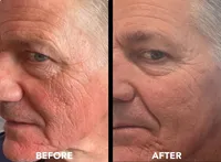 microneedling+3