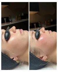 skin-and-facials-before-and-after-beau-montana-3