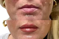 lips+hope