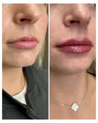 lip-filler-injectable-before-and-after-beau-montana-3