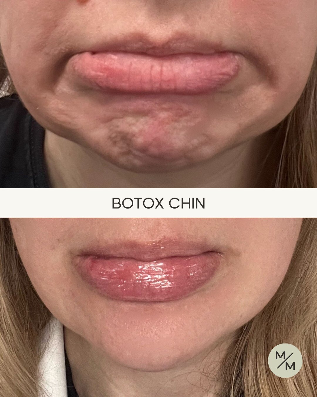 Botox in Hooksett & Plymouth, NH | Modern Medspa