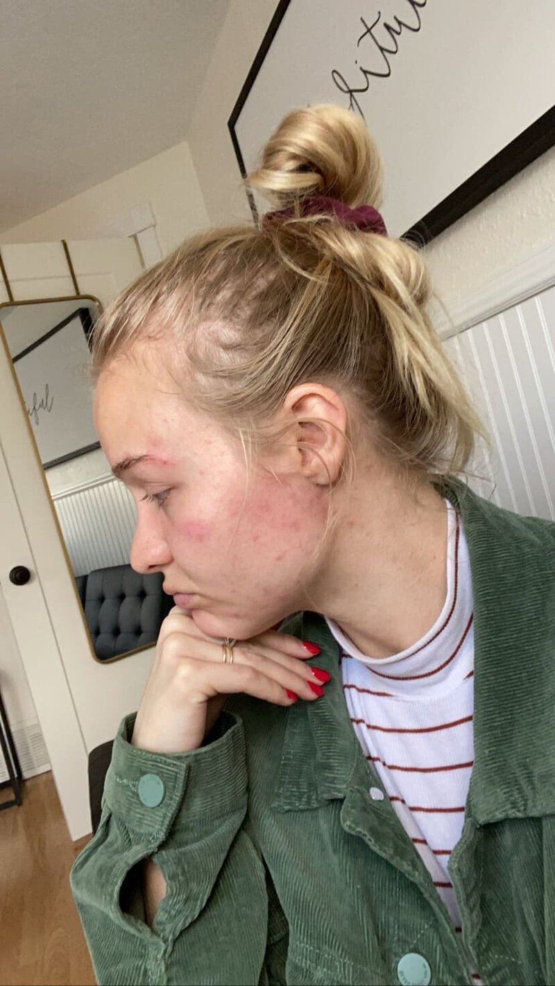 Before Lissy Skincare 3