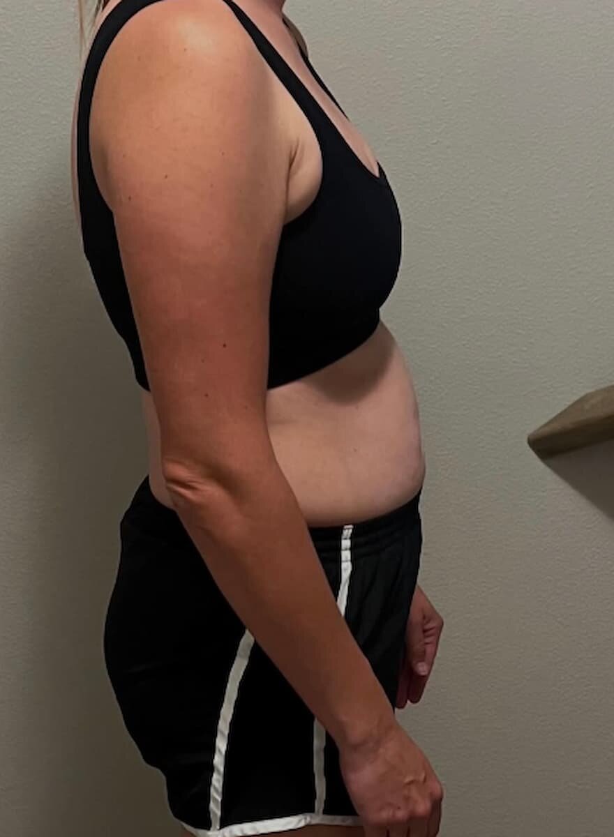 Megan’s before photo, side view