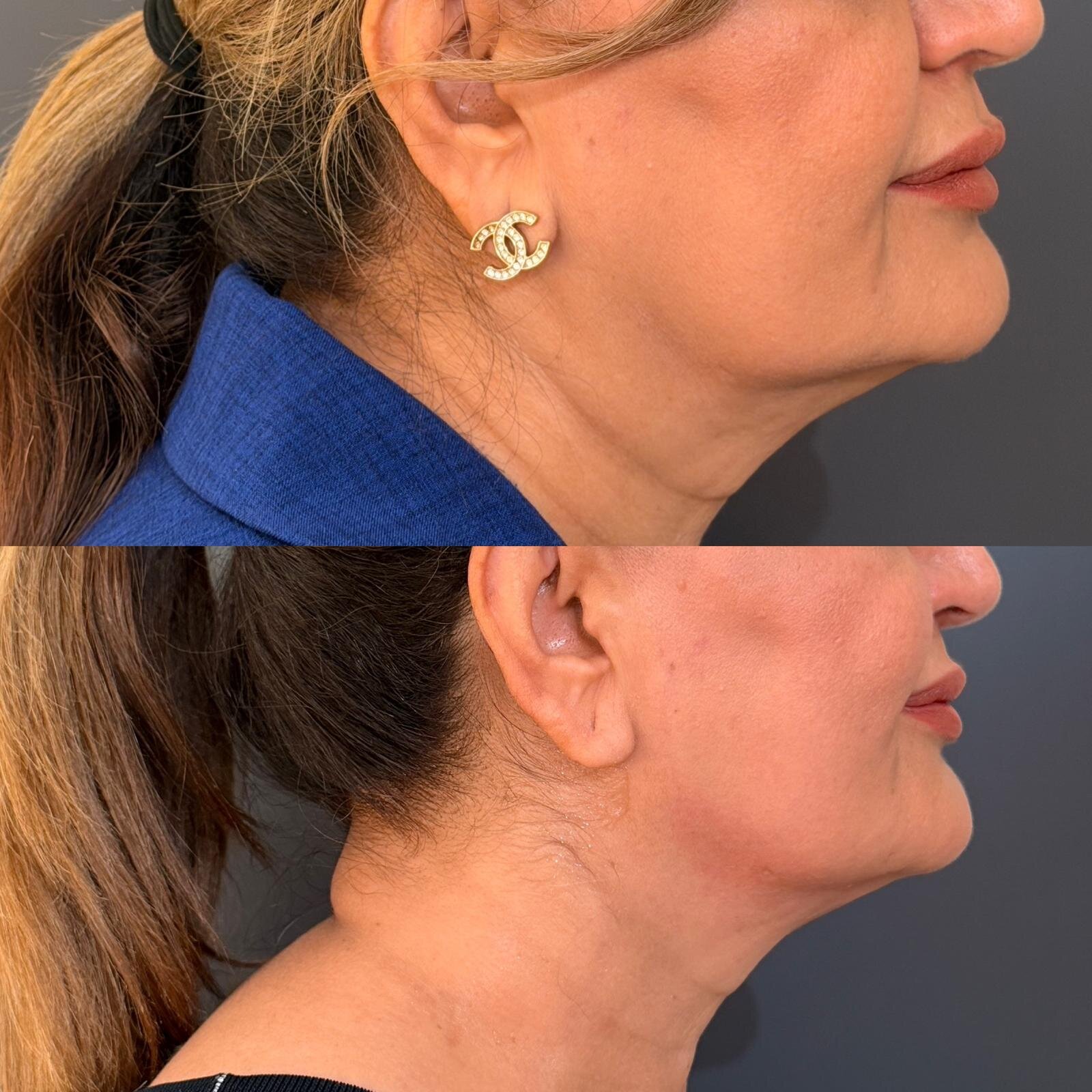 Skin Tightening After