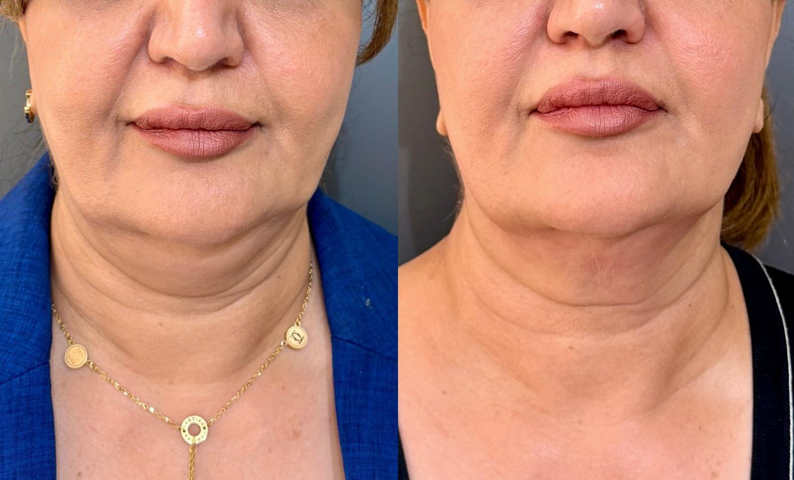 Skin Tightening After