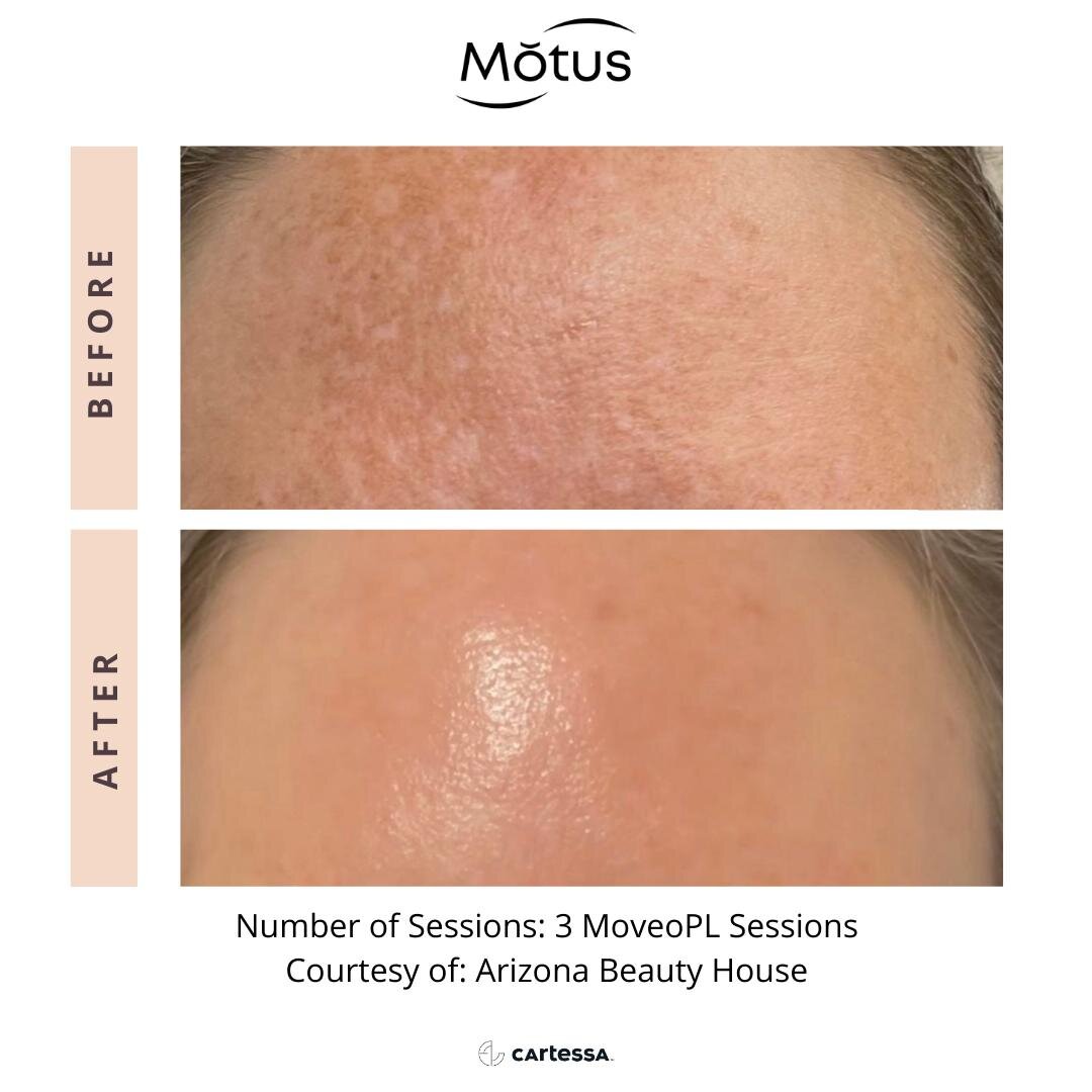 Before and after vascular treatments treatment with Motus Pro