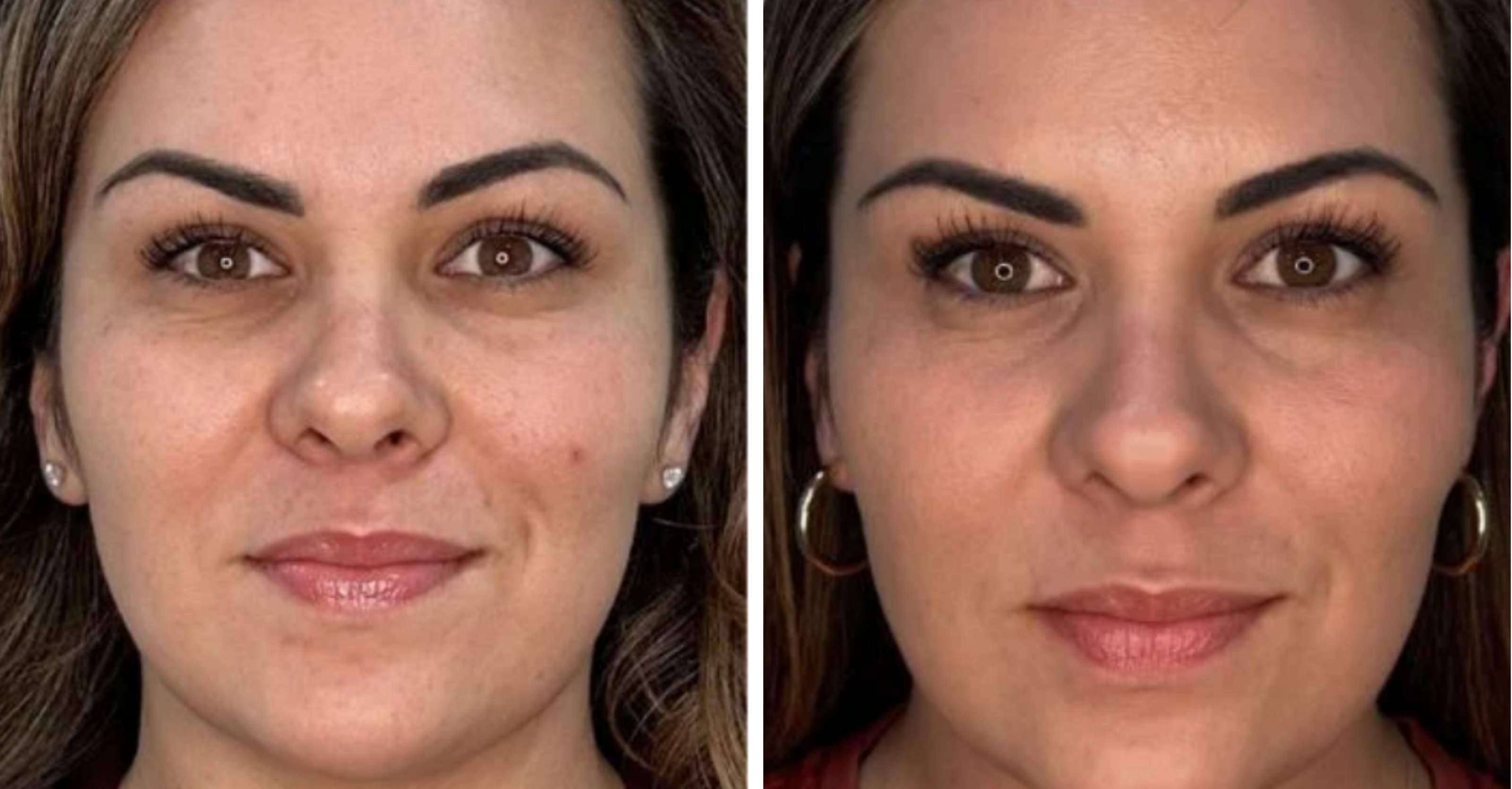Lunchtime Facelift