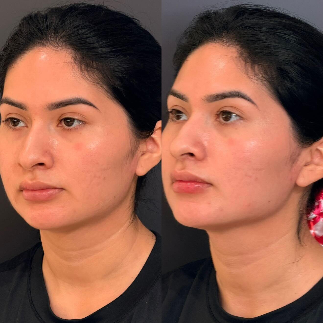 Skin Tightening After