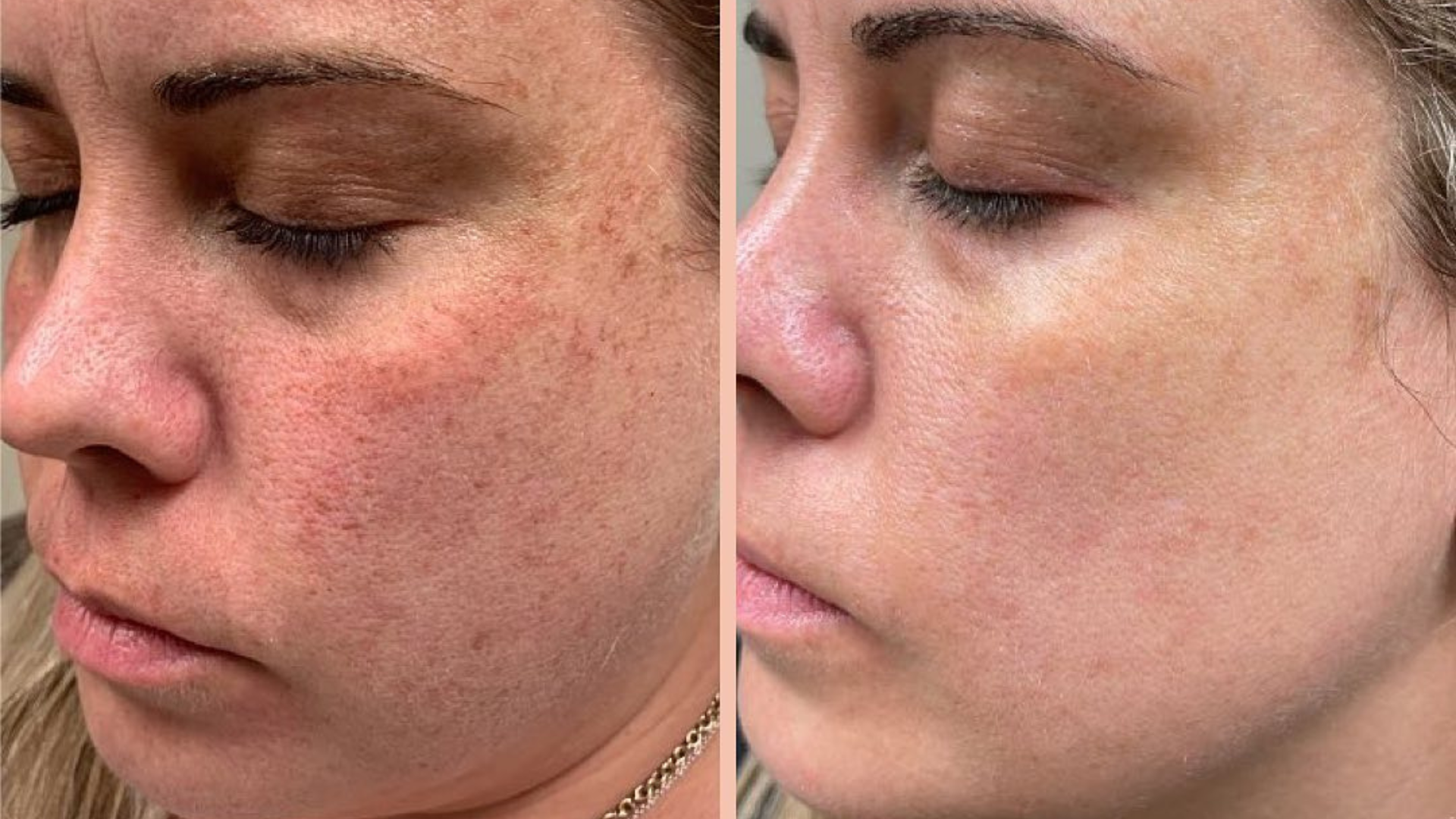 IPL Photofacials