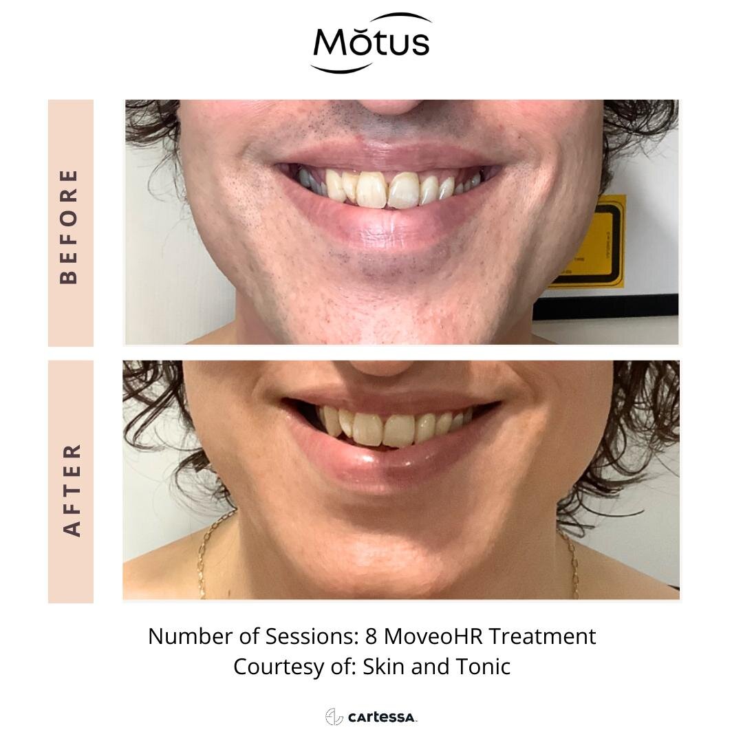 Before and after skin rejuvenation treatment with Motus Pro