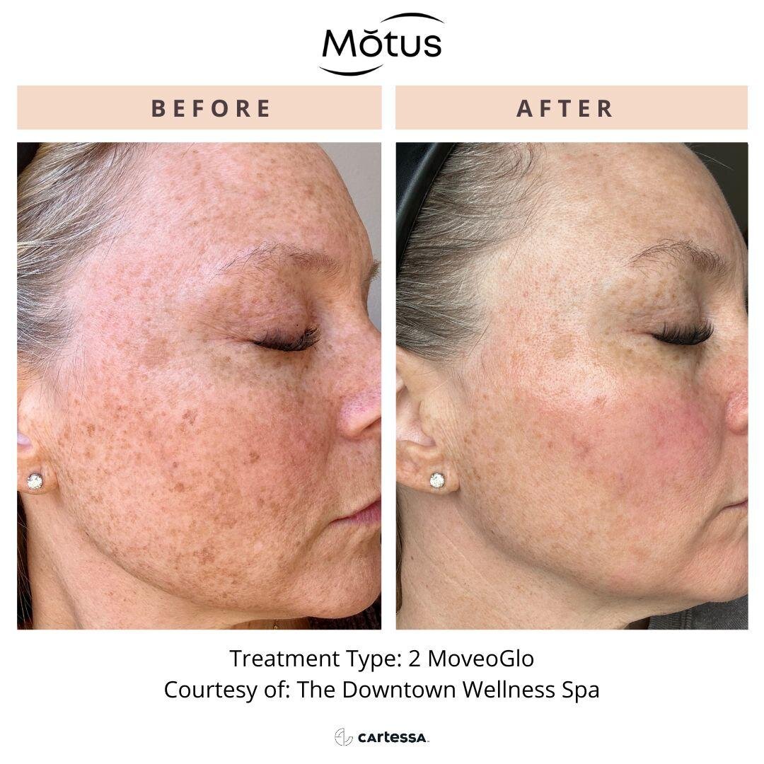 Before and after pigmentation correction treatment with Motus Pro