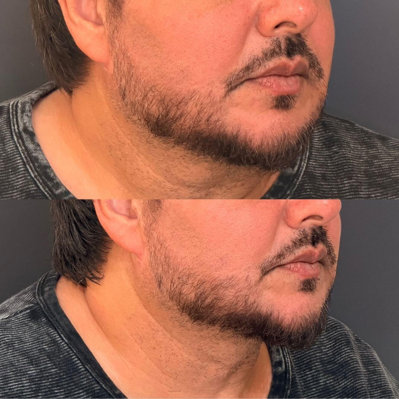 Skin Tightening After