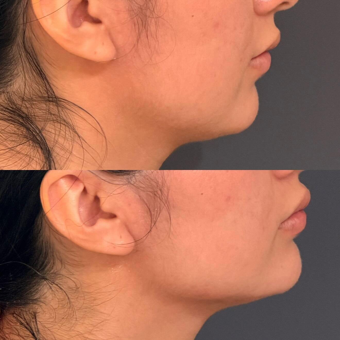Skin Tightening After