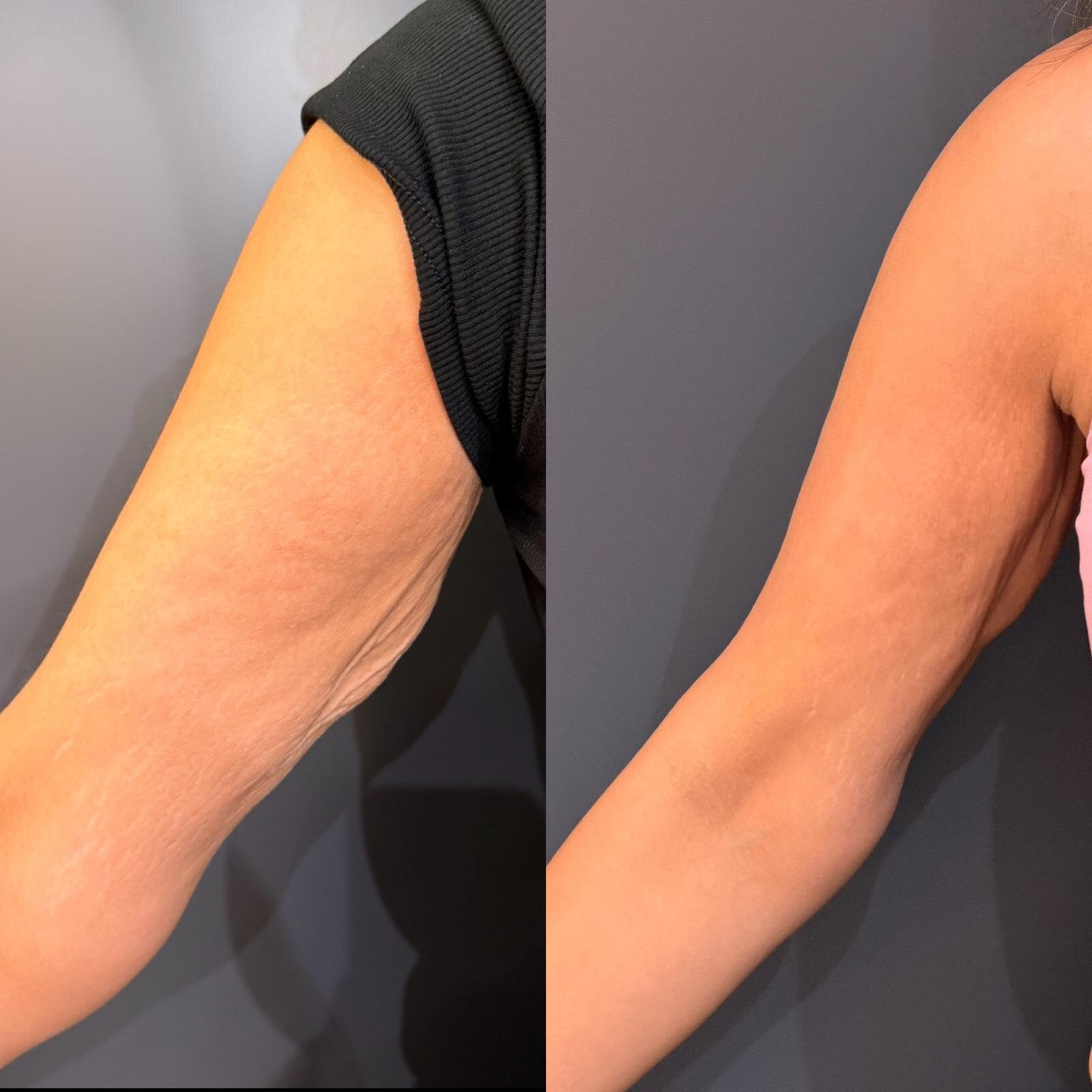 Skin Tightening After