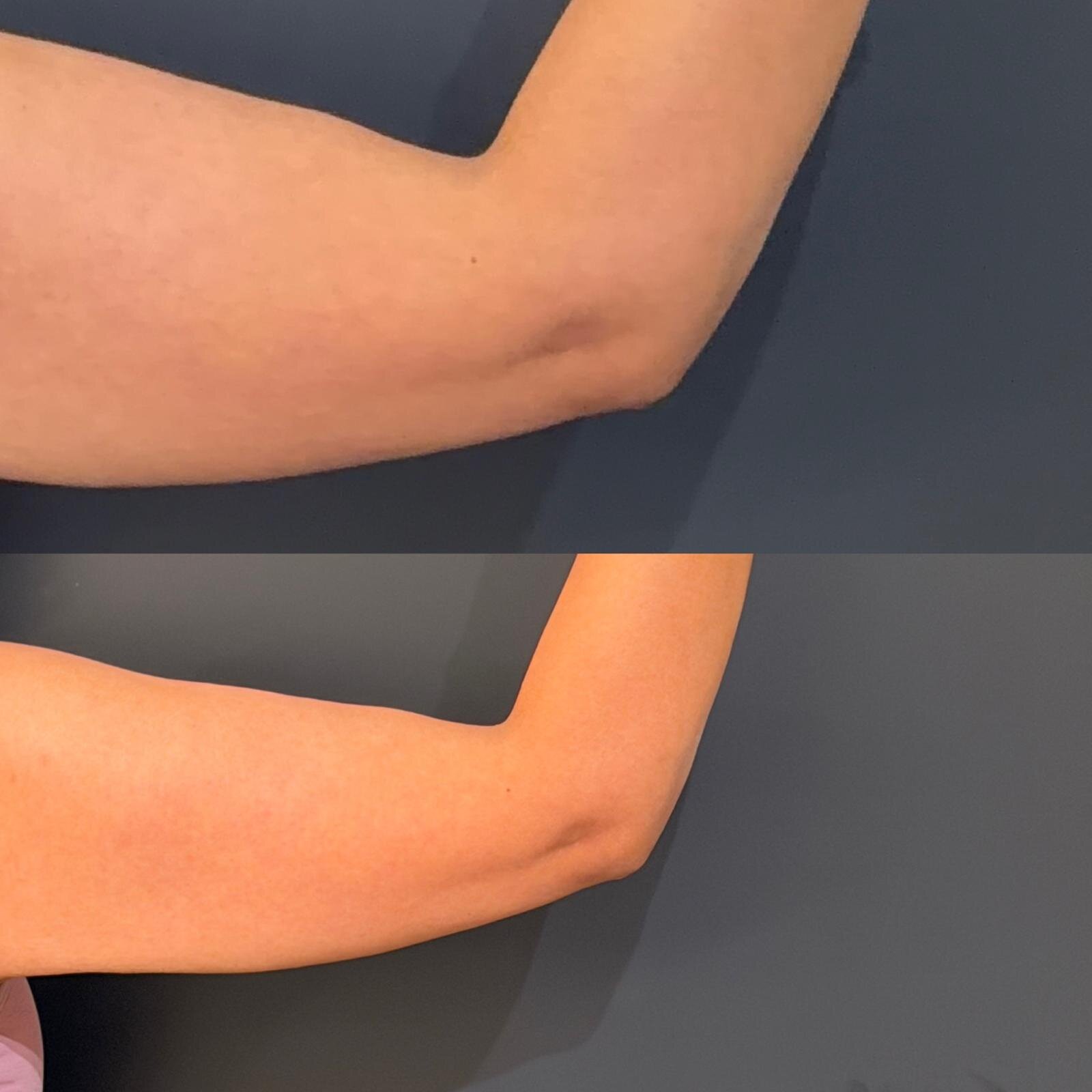 Skin Tightening After