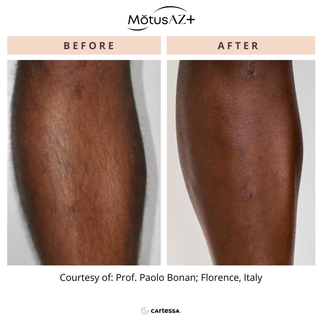 Before and after hair removal treatment with Motus Pro